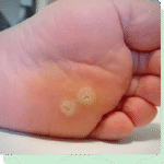 Plantar Wart Removal Doctor Perth Amboy